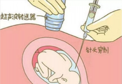 羊水穿刺是什么？