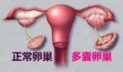 多囊卵巢可以受孕吗