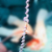 “脐带真结”+“脐带扭转40圈” 产科生死时速助